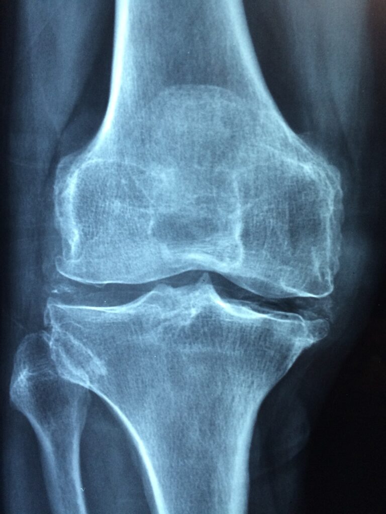 Arthritis Cure Treatments